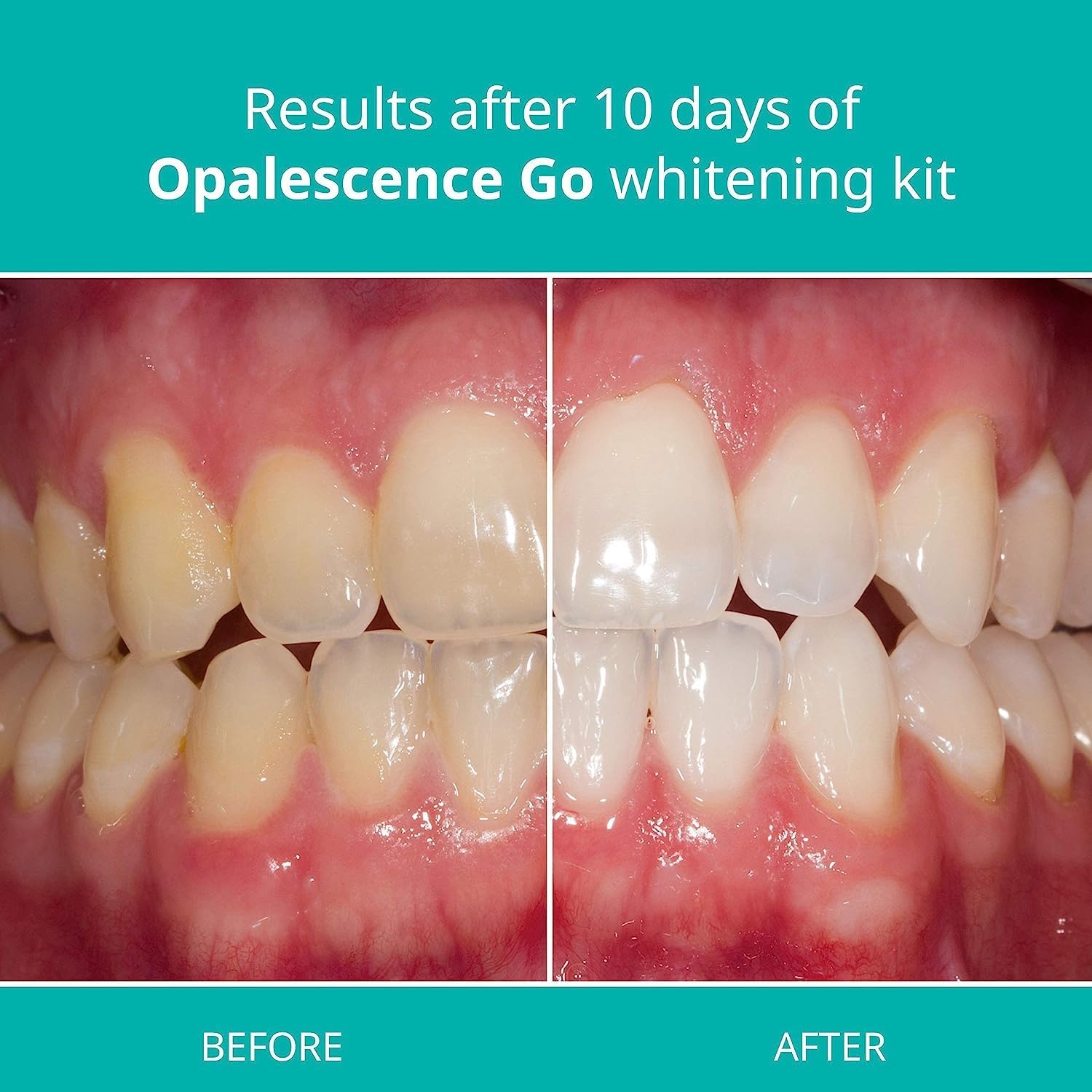 Opalescence Go 15 - Prefilled Whitening Trays, 10 Treatments, Mint