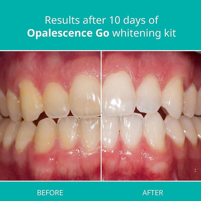 Opalescence Go 15 - Prefilled Whitening Trays, 10 Treatments, Mint