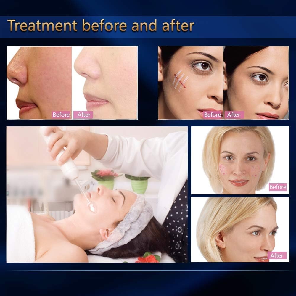 Titoe High F Rrequency Facial Wand Multi-Function Face Device Machine for Face Care