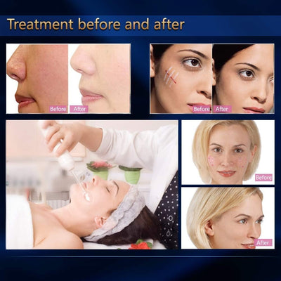 Titoe High F Rrequency Facial Wand Multi-Function Face Device Machine for Face Care