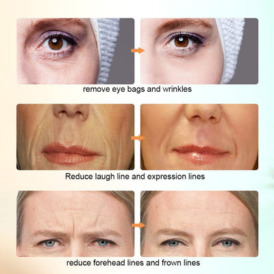 Skin Tightening Machine Face Lifting Device For Wrinkle Anti Aging EMS Skin Rejuvenation Radio Frequency Facial Massager